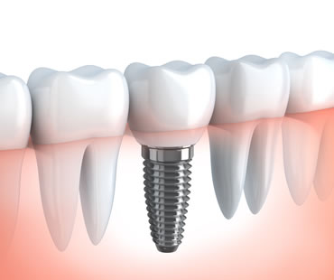 At What Age Do I Need Dental Implants?