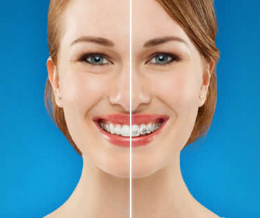 Get Ready for Invisalign!