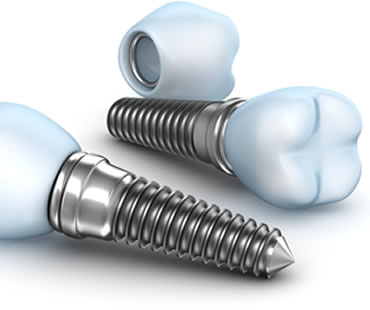 Complete Your Smile with Dental Implants