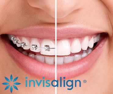 Adults: Living with Invisalign