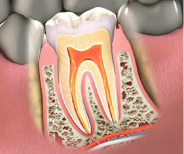 How Much Pain Does a Root Canal Involve?