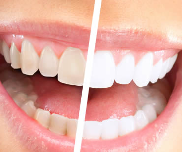 How to Enjoy a Whiter Smile