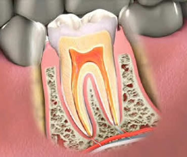 Signs that Point to a Root Canal