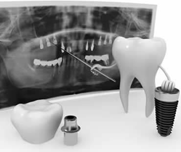 Why Dental Implants Are Becoming a Popular Choice
