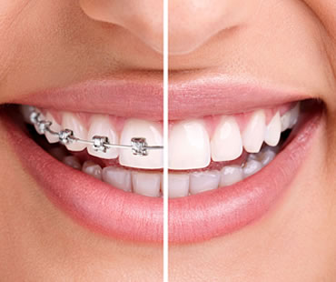 Benefits of Invisalign
