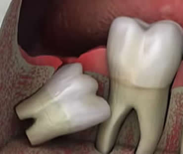 All About Wisdom Teeth: Your Questions Answered