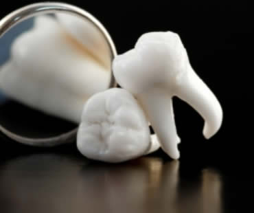 When Is the Right Time to Remove Wisdom Teeth?