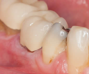 Tips about Receding Gums